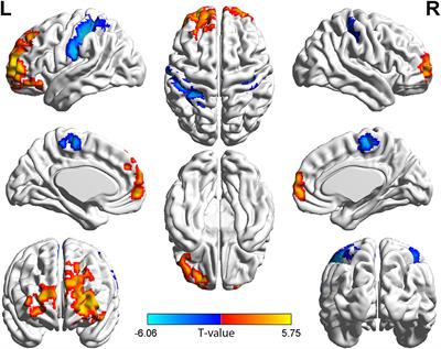 Altered Long- and Short-Range Functional Connectivity Density in Patients With Thyroid-Associated Ophthalmopathy: A Resting-State fMRI Study